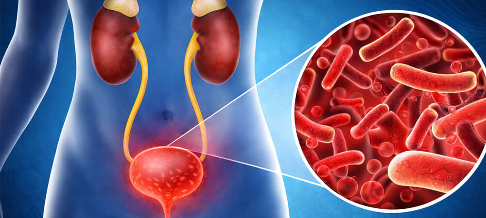 Urinary Tract Infections (UTI)